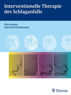 cover image of Interventionelle Therapie des Schlaganfalls